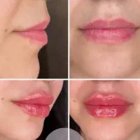 تزریق ژل و بوتاکس با قیمت عالی/مدل تزریق فیلر بدن