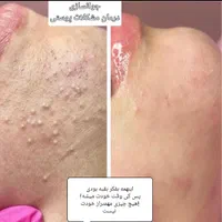 فیشیال و پاکسازی تخصصی ودرمان مشکلات پوستی(تخفیف)|خدمات آرایشگری و زیبایی|گرگان, |دیوار