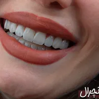کامپوزیت دندان- لمینیت- ونیر- عصب کشی- پروتز|خدمات آرایشگری و زیبایی|تهران, نارمک جنوبی|دیوار