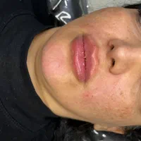 ساکشن وتزریق چربی فیلروبوتاکس وپی ارپی سروصورت ونخ|خدمات آرایشگری و زیبایی|اندیشه, |دیوار