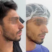 عمل بینی بدون بیهوشی(دائمی)