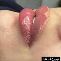 ۵۰ درصد تخفیف فیلر بوتاکس فول فیس