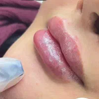 تزریق فیلر(ژل و بوتاکس)|خدمات آرایشگری و زیبایی|خرم‌آباد, |دیوار