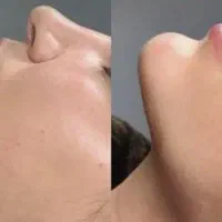 ساکشن غبغب و زاویه سازی فک