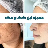 پاک کردن تتو،حذف کک و مک،کربن تراپی