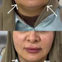 هایفو تراپی
