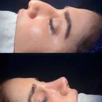 آف عمل جراحی زیبایی بینی ۲۳تومن دراهواز