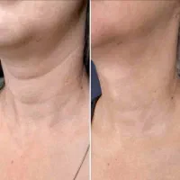 لاغری و جوانسازی با دستگاه هایفو(زیبایی و پزشکی)|خدمات آرایشگری و زیبایی|مسجد سلیمان, |دیوار