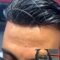 پروتز  مو در سالن مجهز