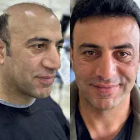 کاشت مو دکترپیوند/تیم شیرازی/اقساطی + 40٪ تخفیف