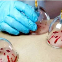 حجامت پاییزی و زالو درمانی حکمت