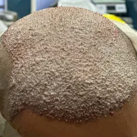 کاشت مو پر تراکم