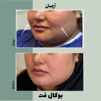 لیپو ساکشن غبغب و بوکال فت ( + شرایط )|خدمات آرایشگری و زیبایی|مشهد, گلبرگ شمالی|دیوار