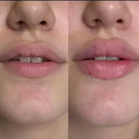 تخفیفات ویژه بوتاکس صورت و فیلر لب،فول فیس و...|خدمات آرایشگری و زیبایی|مشهد, شهید فرامرز عباسی|دیوار