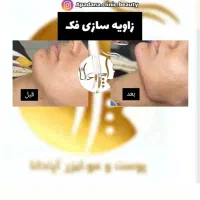 جشنواره تزریق ژل ۳۸۰ هزاروبوتاکس توسط کادردرمان|خدمات آرایشگری و زیبایی|اندیمشک, |دیوار