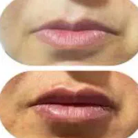 آموزش تزریق ژل وبوتاکس
