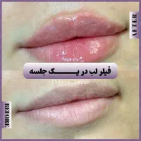 تخفیفات ۵۰% دکتر بوتاکس مزو فیلر ژل لب روسی|خدمات آرایشگری و زیبایی|مشهد, هنرستان|دیوار