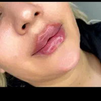 تزریق ژل و بوتاکس تخصصی فیلر سی سی فقط فقط ۱تومن