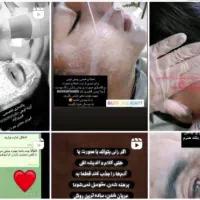 اصلاح خیس صورت