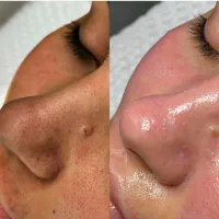 متخصص فیشال، کربن تراپی و لیزر با مدرک تخصصی