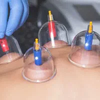حجامت و بادکش درمانی زیر نظر پزشک