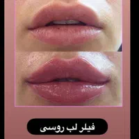 فیلر وژل وبوتاکس|خدمات آرایشگری و زیبایی|تهران, کیانشهر|دیوار