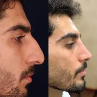تغییر فرم بینی با روش رینوپلاستی نوین|خدمات آرایشگری و زیبایی|رشت, سعدی (تختی)|دیوار