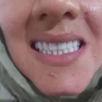 دندان متحرک مصنوعی بقیمت سنندج۶/۵ زرین آباد ایجرود|فعالیت داوطلبانه تحقیقاتی|زنجان, |دیوار