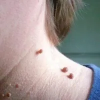خدمات خالبرداری،برداشتن منگوله گوشتی|خدمات آرایشگری و زیبایی|تهران, مسعودیه|دیوار