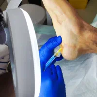 درمان تخصصی انواع زخم در ایلام با دستگاه مدرن