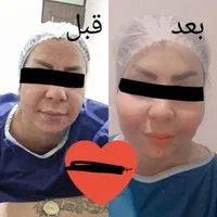 تزریق چربی صورت|خدمات آرایشگری و زیبایی|یاسوج, |دیوار