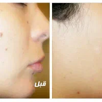 حذف خال، کک و مک و زوائد پوستی با کمترین قیمت|خدمات آرایشگری و زیبایی|یاسوج, |دیوار