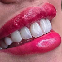 خدمات کامپوزیت و لمینیت دندان و پروتزهای دندانی