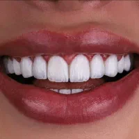 کامپوزیت دندان|خدمات آرایشگری و زیبایی|ری, دیلمان|دیوار