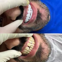 کامپوزیت دندان|خدمات آرایشگری و زیبایی|کرج, شهر جدید اندیشه|دیوار