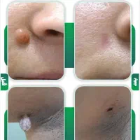 خالبرداری و زگیل و... ویژه آقایان