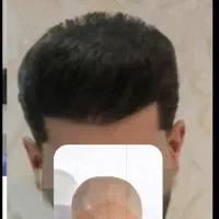 کاشت موی شیرازی|خدمات آرایشگری و زیبایی|مریوان, |دیوار