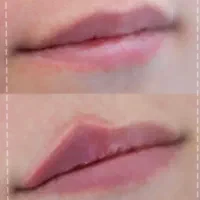 تخفیف برای فیلر لب شهرکرد
