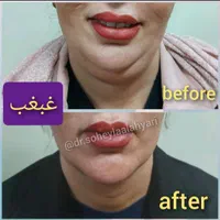 غبغب بوکال لیفت شقیقه سانترال چربی ژل بوتاکس