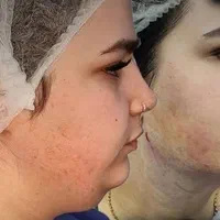 لیپو ساکشن غبغب۶۹۰۰ تخلیه چربی شکم و پهلو ۱۹میلیون|خدمات آرایشگری و زیبایی|اصفهان, احمدآباد|دیوار