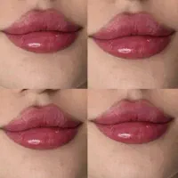 ژل‌ فیلر بوتاکس انزیم مزوژل اموزش خالبرداری فولفیس