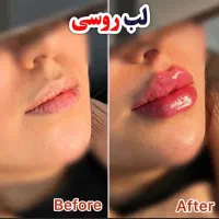 تخفیفات  ژل و بوتاکس توسط پزشک مجرب