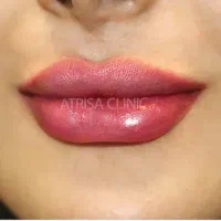 اپراتور تزریق ژل و اپراتور دستگاه لیزر