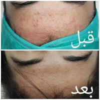 پاکسازی پوست،درمان منافذ باز،آکنه،تخلیه سر سیاه|خدمات آرایشگری و زیبایی|اهواز, سپیدار|دیوار