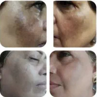 جوانسازی و مراقبت تخصصی پوست بدون تزریق|آرایشی، بهداشتی، درمانی|مشهد, الهیه|دیوار