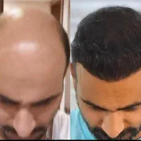 کاشت مو|خدمات آرایشگری و زیبایی|شیراز, زرگری|دیوار