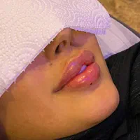 تزریق ژل بوتاکس مزوتراپی پاکسازی جوانسازی|خدمات آرایشگری و زیبایی|تهران, نیروی هوایی (پیروزی)|دیوار