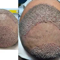 تخفیف ویژه کاشت مو و ابرو با تراکم بالا وطبیعی