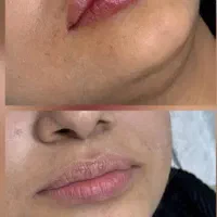 تزریق بوتاکس فیلر انزیم prp مزوتراپی جوانسازی|خدمات آرایشگری و زیبایی|کرمانشاه, |دیوار