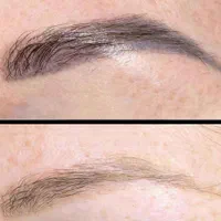 حذف انواع تاتو و خالکوبی با کیوسوئیچ